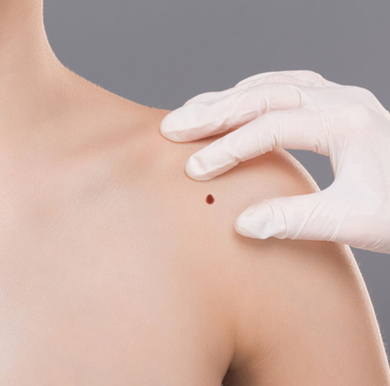 Chirurgie bij huidletsels
