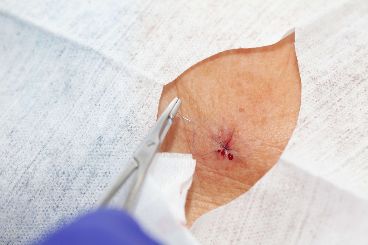 Dermatologische chirurgie