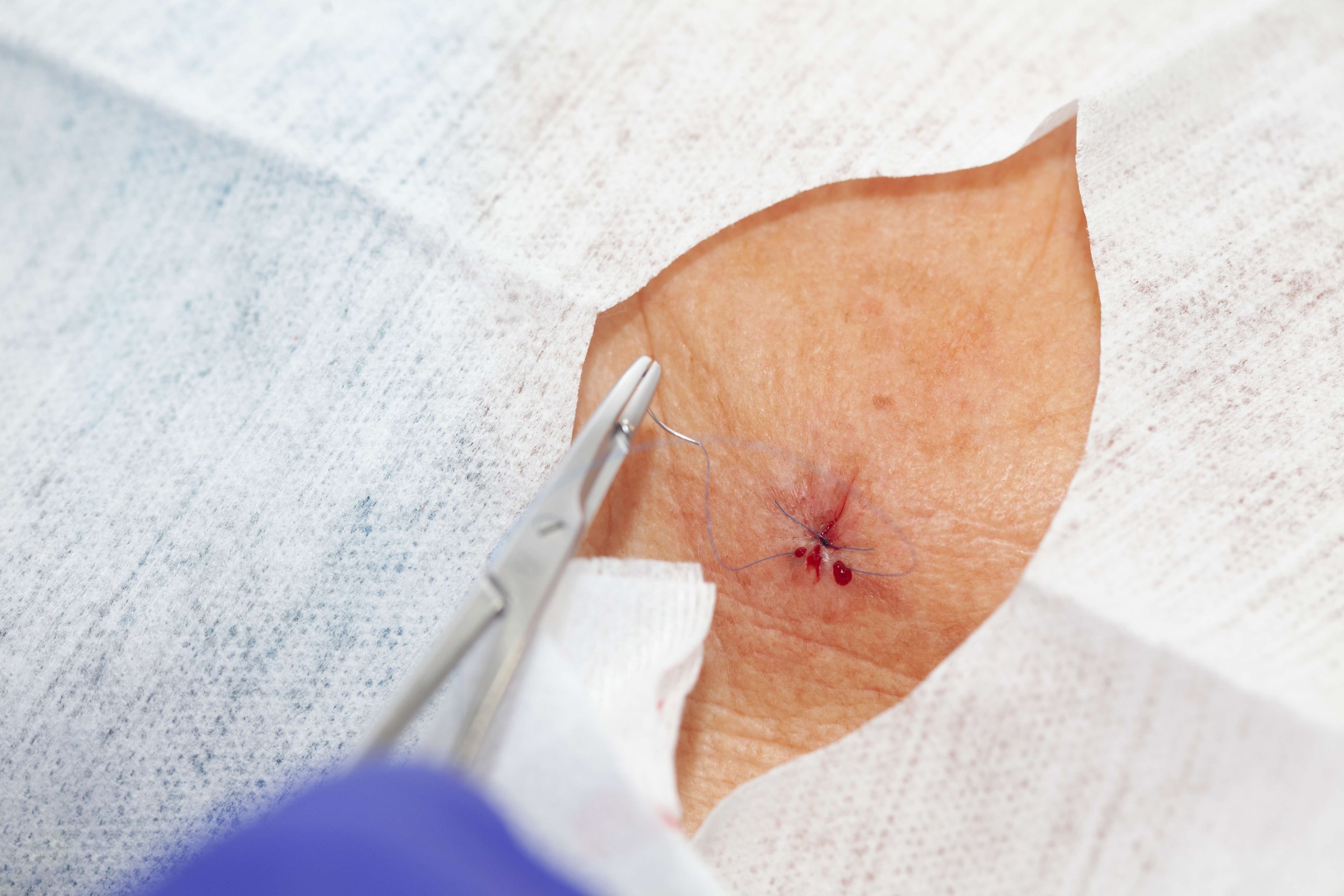 Dermatologische chirurgie