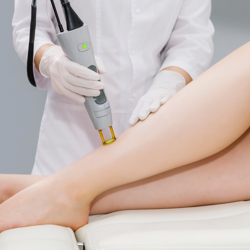 Laser hair removal